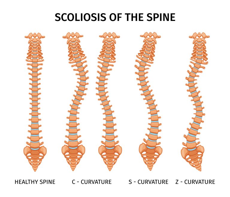 scoliosis of the spine
