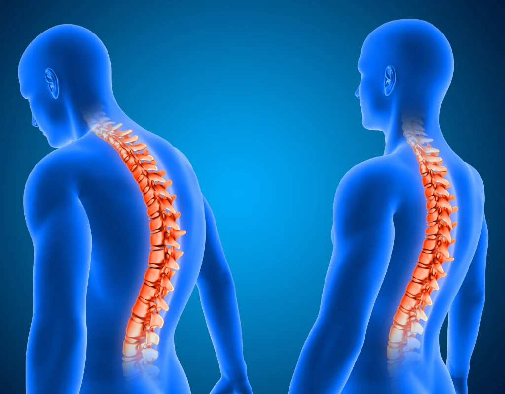 slipped disc pressing on nerve illustration